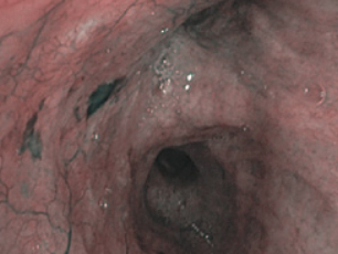 An image inside the lung captured with NBI technology