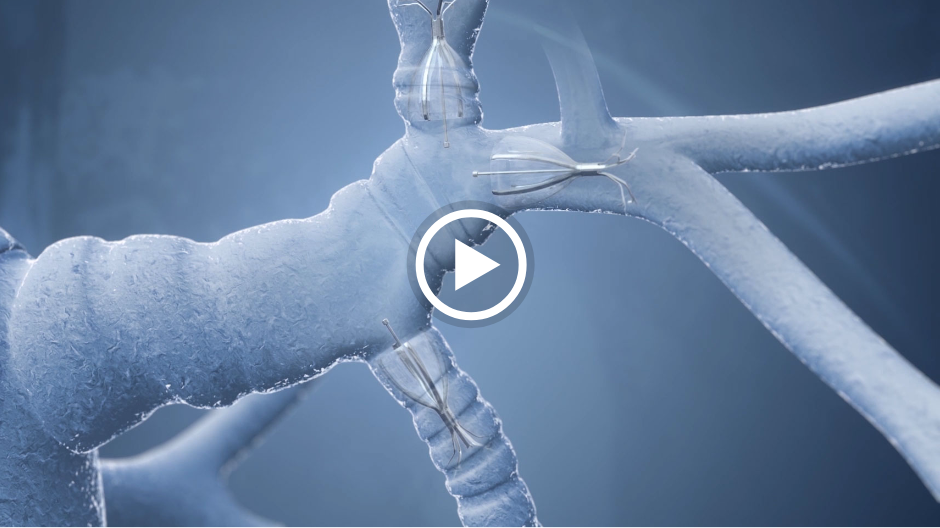 Spiration Valve System: Emphysema Animation