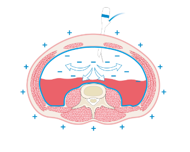 Electrostatic Precipitation